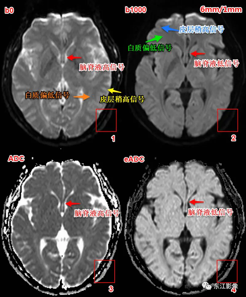 头颅mri-头颅MRI入门系列之认识序列-3